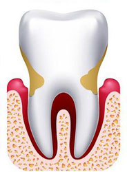 parodontoz