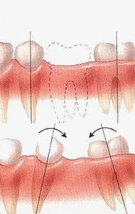 деформация зубов