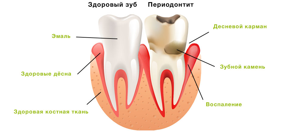 Лечение периодонтита